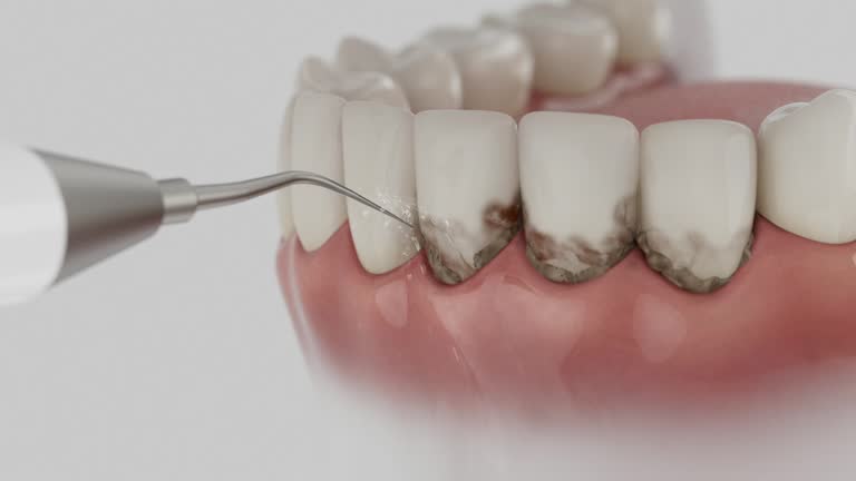 Reliable Dental Implants contractor in Macon, IL by Smile Center Dentistry
